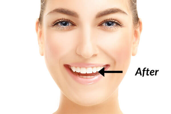 Dental Veneers