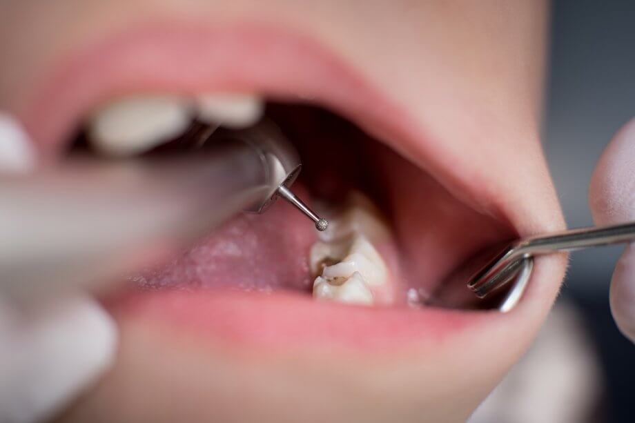 How Long Do Composite Fillings Last?