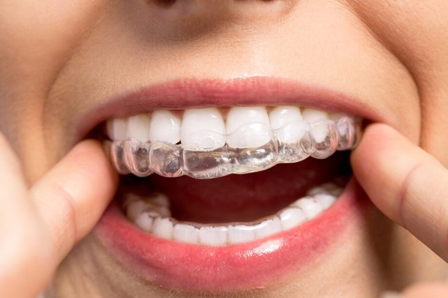 How Long Does Invisalign Take?