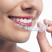 Invisalign Appliance